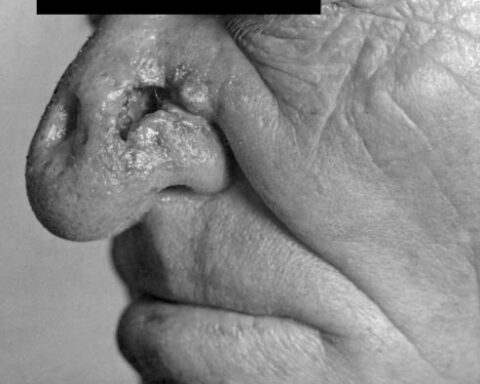 Antallet af europæere, der får konstateret syfilis, gonorré og klamydia stiger markant hvert år